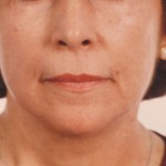 Face - After Face - After