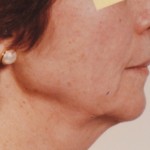 Neck - Before Neck - Before