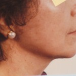 Neck - After Neck - After