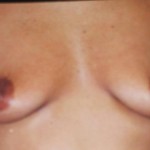 Before Before