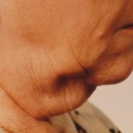 Neck - Before Neck - Before