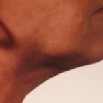 Neck - After Neck - After