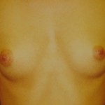 Before Before