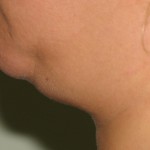 Before Before