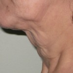 Neck - Before Neck - Before