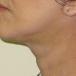 Neck - After Neck - After