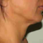 Neck - Before Neck - Before