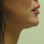 Neck - After Neck - After